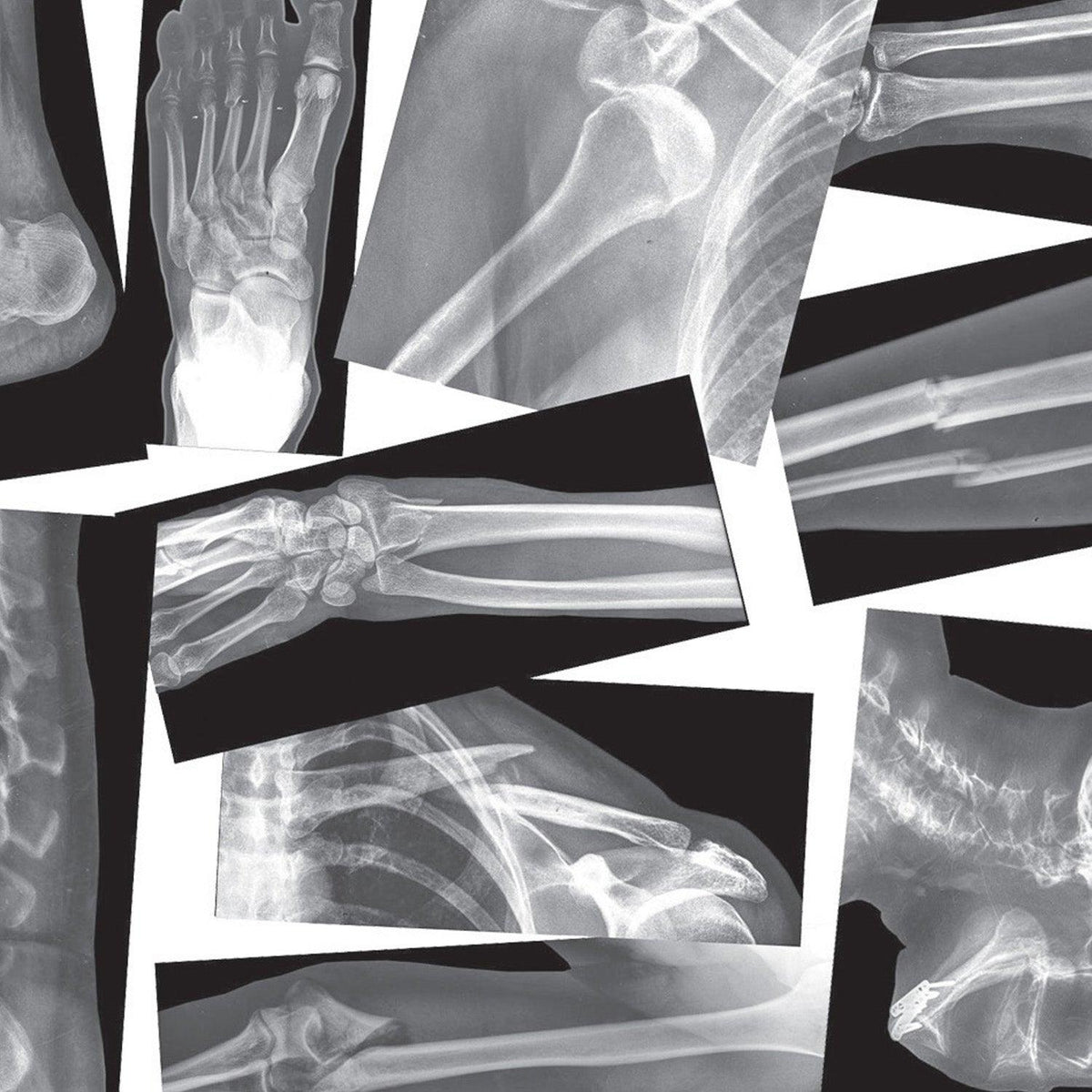 Xbone Rays Broken Bones X-Ray Set, Pack of 15 - Loomini