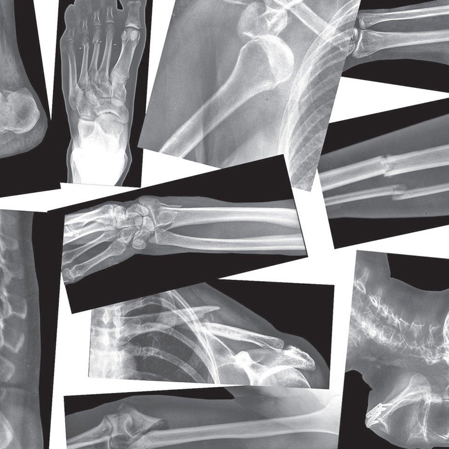 Broken Bones X-Ray Set, Pack of 15 - Loomini