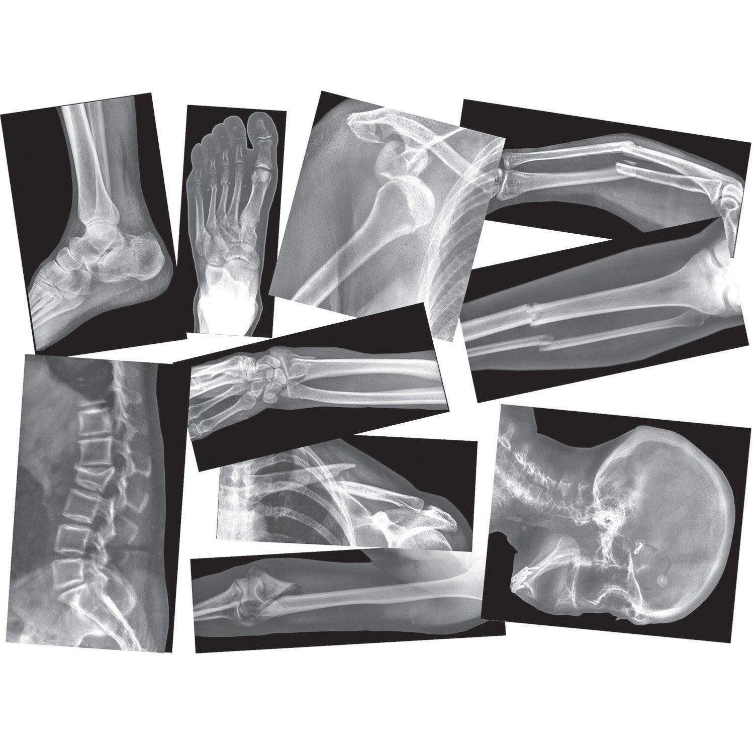 Broken Bones X-Ray Set, Pack of 15 - Loomini